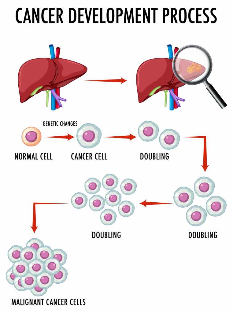 "Illustration showing the cancer development process, including stages of normal cell mutation, uncontrolled cell growth, tumor formation, and metastasis.